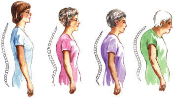 Osteoporoz nedir?  Fizik Tedavi ve Rehabilitasyon Uzmanı yazdı...